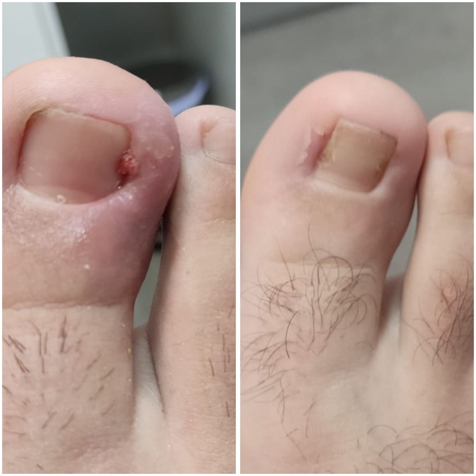 ANTES Y DESPUES CIT¡RUGIA UÑA ENCARNADA